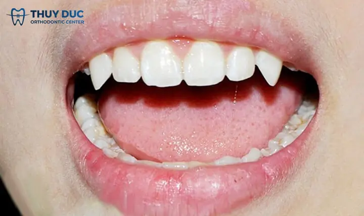 Tướng Răng Nanh Nhọn Ởnuwx Tướng Răng Nanh Nhọn Ởnuwx