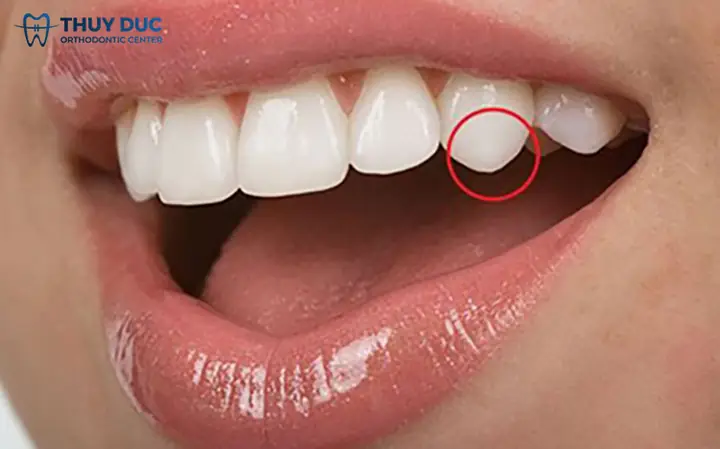 Tướng Răng Nanh Nhọn Ởnuwx Tướng Răng Nanh Nhọn Ởnuwx
