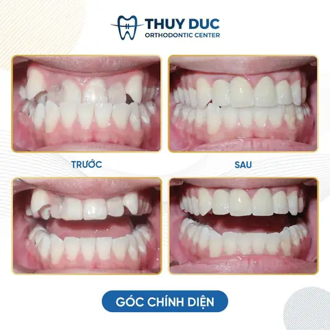 Tướng Răng Nanh Nhọn Ởnuwx Tướng Răng Nanh Nhọn Ởnuwx