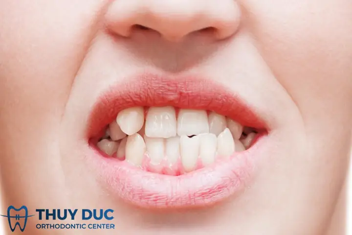 Tướng Răng Nanh Nhọn Ởnuwx Tướng Răng Nanh Nhọn Ởnuwx