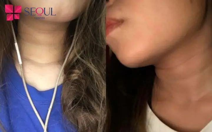 Tướng Số Cổ 3 Ngấn Tướng Số Cổ 3 Ngấn