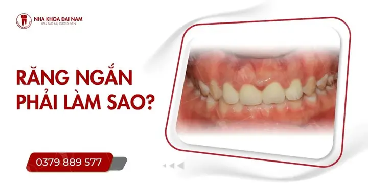Tướng Số Qua Răng