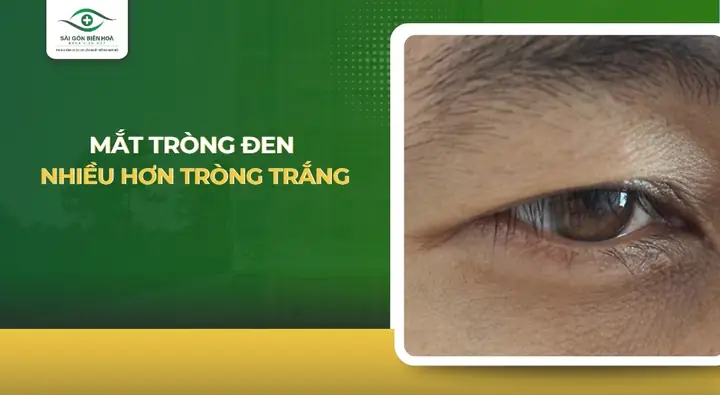 Xem Tướng Mắt Toàn Lòng Đen Xem Tướng Mắt Toàn Lòng Đen