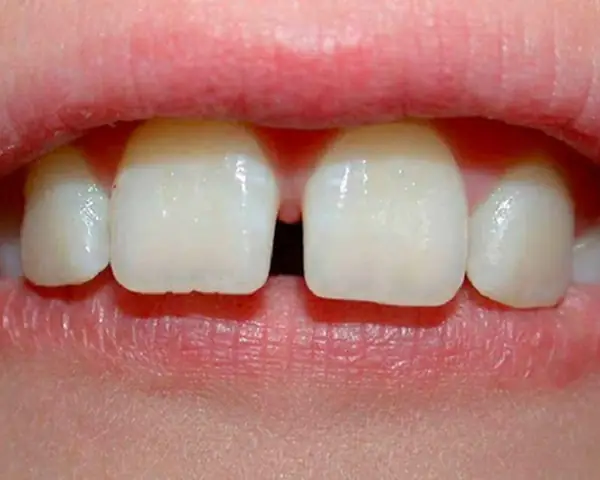 Xem Tướng Răng Cửa Hở