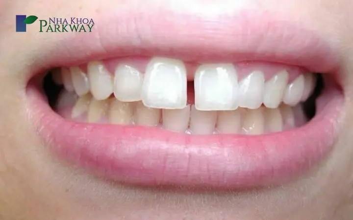 Xem Tướng Răng Cửa Hở