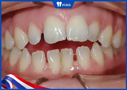 Xem Tướng Răng Thưa Hàm Dưới Xem Tướng Răng Thưa Hàm Dưới