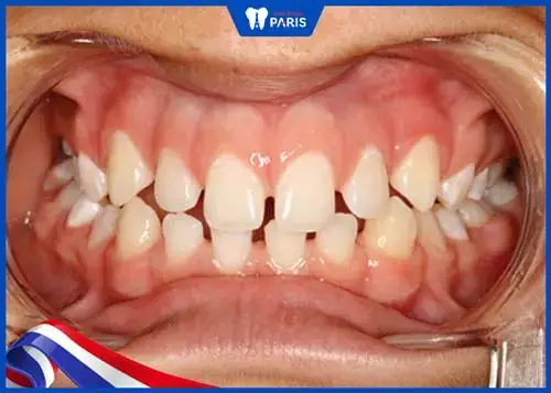 Xem Tướng Răng Thưa Hàm Dưới Xem Tướng Răng Thưa Hàm Dưới
