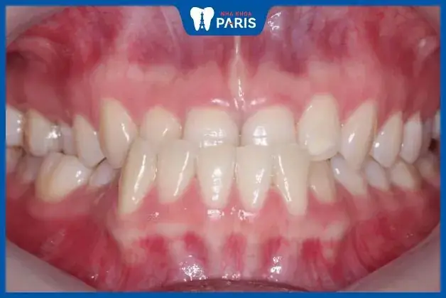Xem Tướng Số Qua Hàm Răng Xem Tướng Số Qua Hàm Răng