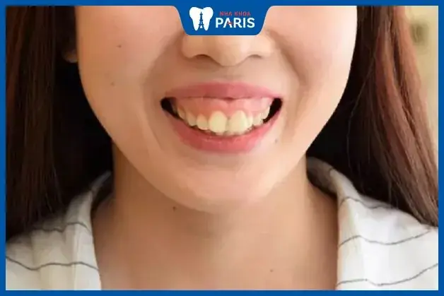 Xem Tướng Số Qua Hàm Răng Xem Tướng Số Qua Hàm Răng