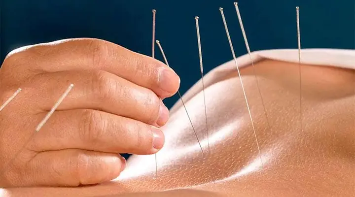 Top 7 Địa Chỉ Châm Cứu Bấm Huyệt Uy Tín Tại Quận Gò Vấp
