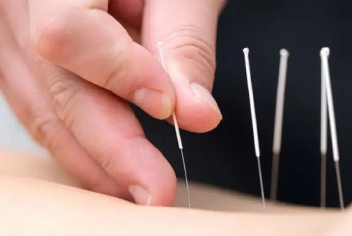 Top 7 Địa Chỉ Châm Cứu Bấm Huyệt Uy Tín Tại Quận Gò Vấp