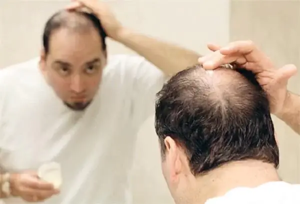 Điềm Báo Giấc Mơ Thấy Tóc Rụng Điềm Báo Giấc Mơ Thấy Tóc Rụng
