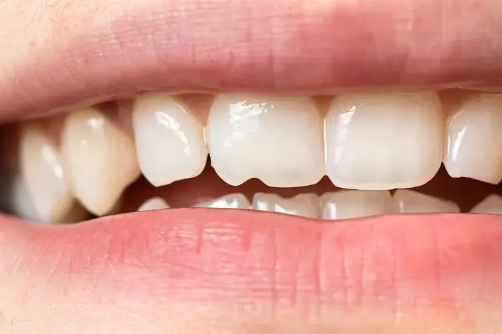 Giải Mã Giấc Mơ Bị Mẻ Răng: Ý Nghĩa, Dự Báo Và Cách Đối Phó Giải Mã Giấc Mơ Bị Mẻ Răng: Ý Nghĩa, Dự Báo Và Cách Đối Phó