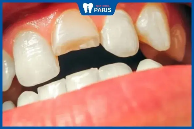 Giải Mã Giấc Mơ Bị Mẻ Răng: Ý Nghĩa, Dự Báo Và Cách Đối Phó Giải Mã Giấc Mơ Bị Mẻ Răng: Ý Nghĩa, Dự Báo Và Cách Đối Phó