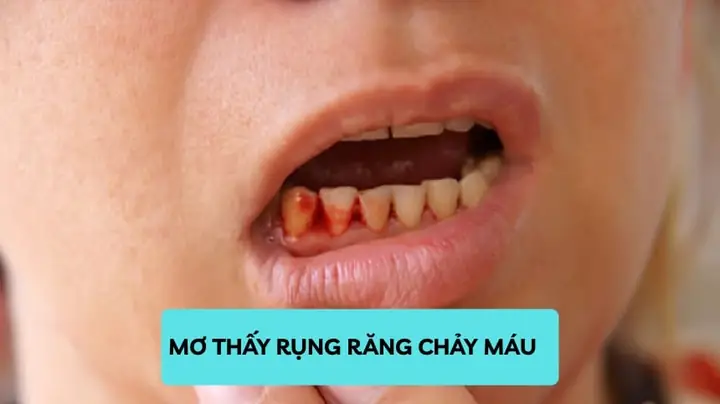 Giải Mã Giấc Mơ Rụng Răng Chảy Máu: Điềm Báo Gì, Tốt Hay Xấu? Giải Mã Giấc Mơ Rụng Răng Chảy Máu: Điềm Báo Gì, Tốt Hay Xấu?
