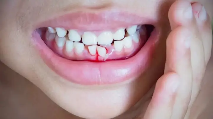 Giải Mã Giấc Mơ Rụng Răng Chảy Máu: Điềm Báo Gì, Tốt Hay Xấu? Giải Mã Giấc Mơ Rụng Răng Chảy Máu: Điềm Báo Gì, Tốt Hay Xấu?