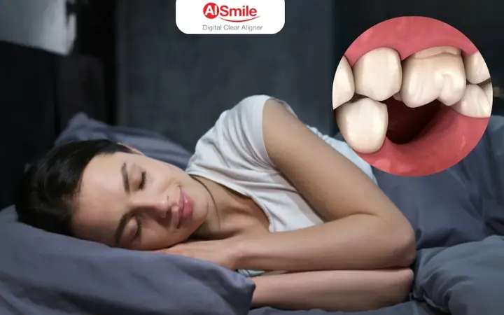 Giải Mã Giấc Mơ Rụng Răng Khểnh: Ý Nghĩa, Nguyên Nhân Và Cách Giải Thích