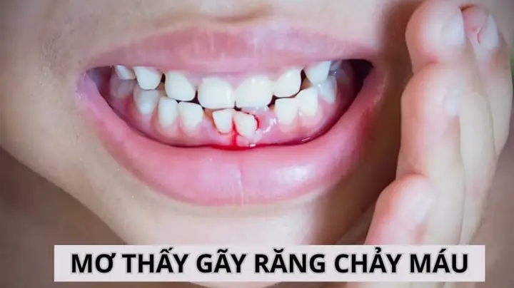Giải Mã Giấc Mơ Thấy Gãy Răng Chảy Máu Giải Mã Giấc Mơ Thấy Gãy Răng Chảy Máu