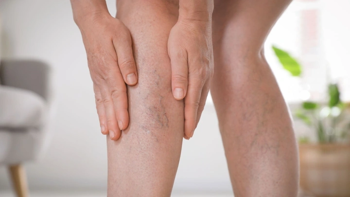 Xem Hình Ảnh Bệnh Giãn Tĩnh Mạch Chân: Nhận Diện, Phân Loại & Điều Trị Cho Người Mới Bắt Đầu