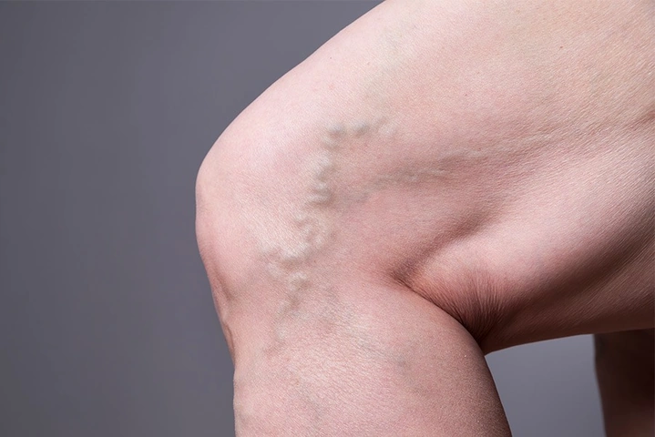 Xem Hình Ảnh Bệnh Giãn Tĩnh Mạch Chân: Nhận Diện, Phân Loại & Điều Trị Cho Người Mới Bắt Đầu