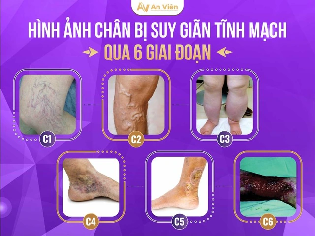 Xem Hình Ảnh Bệnh Giãn Tĩnh Mạch Chân: Nhận Diện, Phân Loại & Điều Trị Cho Người Mới Bắt Đầu