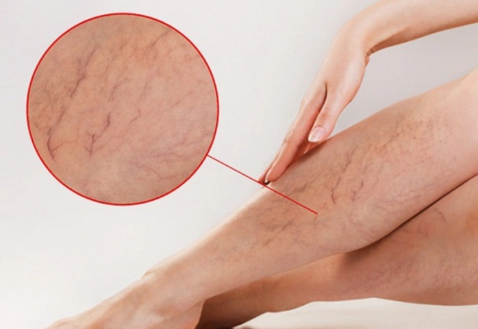 Xem Hình Ảnh Bệnh Giãn Tĩnh Mạch Chân: Nhận Diện, Phân Loại & Điều Trị Cho Người Mới Bắt Đầu