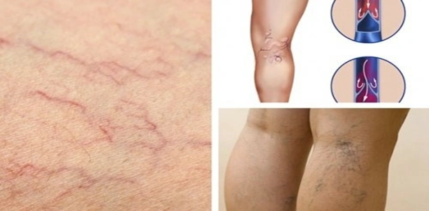 Xem Hình Ảnh Bệnh Giãn Tĩnh Mạch Chân: Nhận Diện, Phân Loại & Điều Trị Cho Người Mới Bắt Đầu
