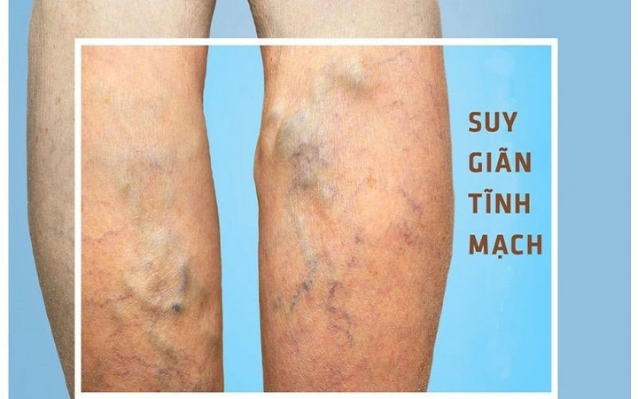 Xem Hình Ảnh Bệnh Giãn Tĩnh Mạch Chân: Nhận Diện, Phân Loại & Điều Trị Cho Người Mới Bắt Đầu
