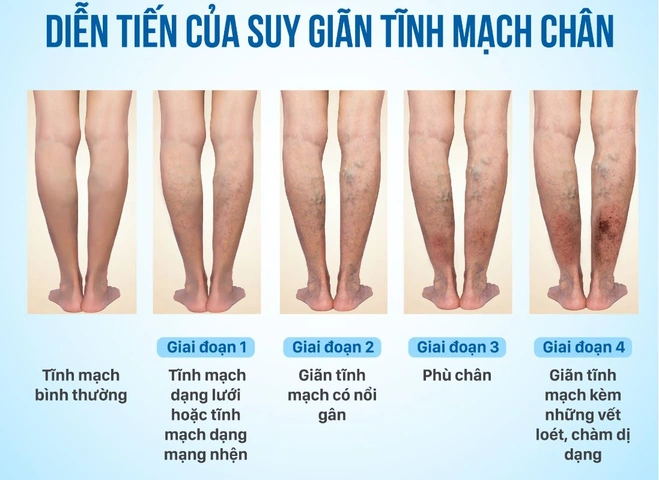 Xem Hình Ảnh Bệnh Giãn Tĩnh Mạch Chân: Nhận Diện, Phân Loại & Điều Trị Cho Người Mới Bắt Đầu
