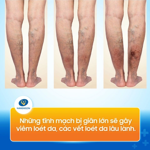 Xem Hình Ảnh Bệnh Giãn Tĩnh Mạch Chân: Nhận Diện, Phân Loại & Điều Trị Cho Người Mới Bắt Đầu