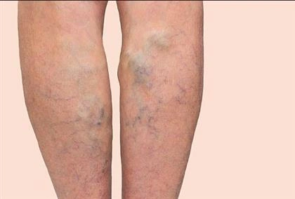 Xem Hình Ảnh Bệnh Giãn Tĩnh Mạch Chân: Nhận Diện, Phân Loại & Điều Trị Cho Người Mới Bắt Đầu