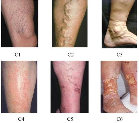 Xem Hình Ảnh Bệnh Giãn Tĩnh Mạch Chân: Nhận Diện, Phân Loại & Điều Trị Cho Người Mới Bắt Đầu