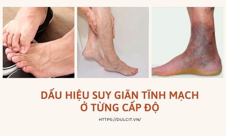 Xem Hình Ảnh Bệnh Giãn Tĩnh Mạch Chân: Nhận Diện, Phân Loại & Điều Trị Cho Người Mới Bắt Đầu