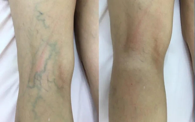 Xem Hình Ảnh Bệnh Giãn Tĩnh Mạch Chân: Nhận Diện, Phân Loại & Điều Trị Cho Người Mới Bắt Đầu