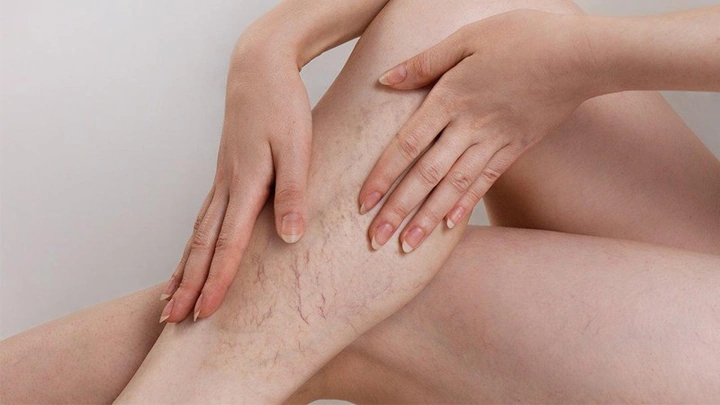 Xem Hình Ảnh Bệnh Giãn Tĩnh Mạch Chân: Nhận Diện, Phân Loại & Điều Trị Cho Người Mới Bắt Đầu