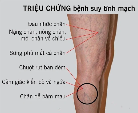 Xem Hình Ảnh Bệnh Giãn Tĩnh Mạch Chân: Nhận Diện, Phân Loại & Điều Trị Cho Người Mới Bắt Đầu