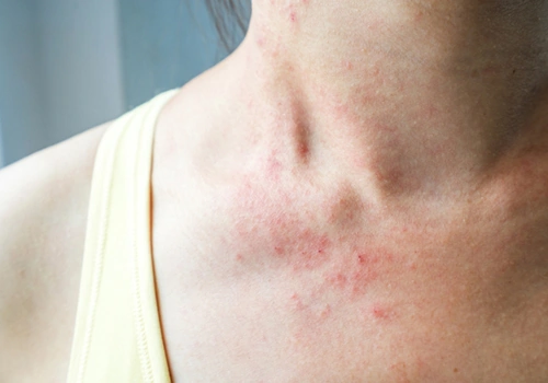 100+ Hình Ảnh Bệnh Nhân Hiv 2026 – Bộ Sưu Tập Đầy Đủ, Đẹp Nhất, Tải Miễn Phí, Bạn Đã Xem Chưa? 100+ Hình Ảnh Bệnh Nhân Hiv 2026 – Bộ Sưu Tập Đầy Đủ, Đẹp Nhất, Tải Miễn Phí, Bạn Đã Xem Chưa?
