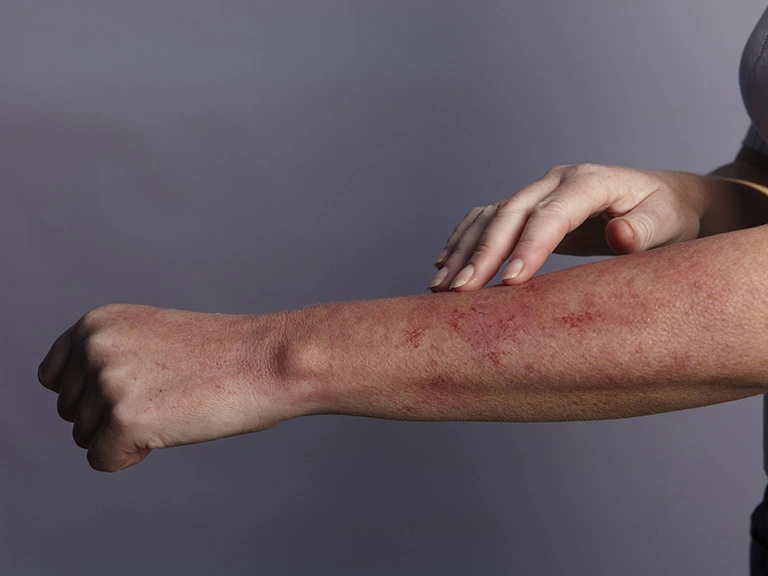 100+ Hình Ảnh Bệnh Nhân Hiv 2026 – Bộ Sưu Tập Đầy Đủ, Đẹp Nhất, Tải Miễn Phí, Bạn Đã Xem Chưa? 100+ Hình Ảnh Bệnh Nhân Hiv 2026 – Bộ Sưu Tập Đầy Đủ, Đẹp Nhất, Tải Miễn Phí, Bạn Đã Xem Chưa?