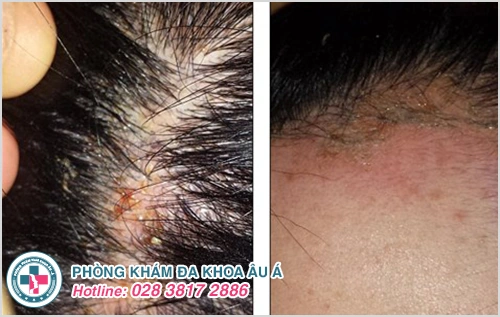 100+ Hình Ảnh Bị Chốc Lở 2026 - Bộ Sưu Tập Đẹp Nhất, Tải Miễn Phí? 100+ Hình Ảnh Bị Chốc Lở 2026 - Bộ Sưu Tập Đẹp Nhất, Tải Miễn Phí?