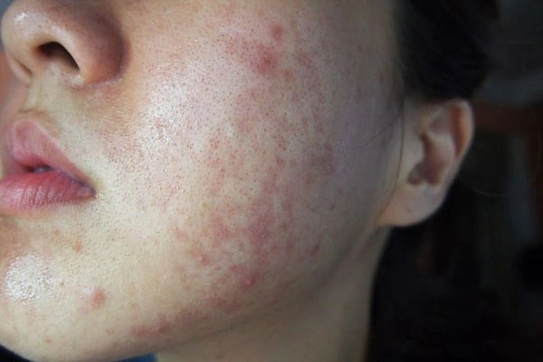 Hình Ảnh Dị Ứng Mỹ Phẩm: Dấu Hiệu, Nguyên Nhân & Cách Xử Lý Nhanh Cho Người Dùng Hình Ảnh Dị Ứng Mỹ Phẩm: Dấu Hiệu, Nguyên Nhân & Cách Xử Lý Nhanh Cho Người Dùng