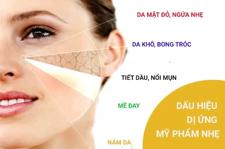 Hình Ảnh Dị Ứng Mỹ Phẩm: Dấu Hiệu, Nguyên Nhân & Cách Xử Lý Nhanh Cho Người Dùng Hình Ảnh Dị Ứng Mỹ Phẩm: Dấu Hiệu, Nguyên Nhân & Cách Xử Lý Nhanh Cho Người Dùng