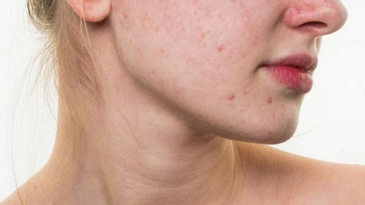 Hình Ảnh Dị Ứng Mỹ Phẩm: Dấu Hiệu, Nguyên Nhân & Cách Xử Lý Nhanh Cho Người Dùng Hình Ảnh Dị Ứng Mỹ Phẩm: Dấu Hiệu, Nguyên Nhân & Cách Xử Lý Nhanh Cho Người Dùng