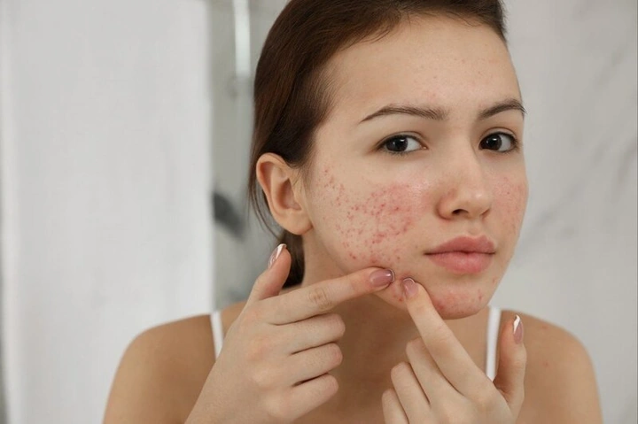 Hình Ảnh Dị Ứng Mỹ Phẩm: Dấu Hiệu, Nguyên Nhân & Cách Xử Lý Nhanh Cho Người Dùng Hình Ảnh Dị Ứng Mỹ Phẩm: Dấu Hiệu, Nguyên Nhân & Cách Xử Lý Nhanh Cho Người Dùng