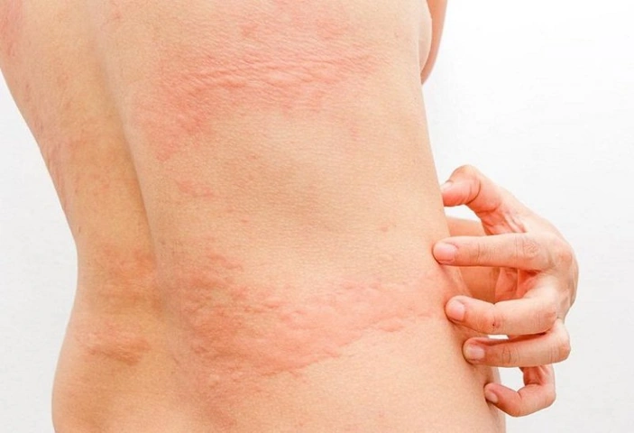 Hình Ảnh Dị Ứng Mỹ Phẩm: Dấu Hiệu, Nguyên Nhân & Cách Xử Lý Nhanh Cho Người Dùng Hình Ảnh Dị Ứng Mỹ Phẩm: Dấu Hiệu, Nguyên Nhân & Cách Xử Lý Nhanh Cho Người Dùng