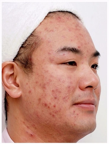 Hình Ảnh Dị Ứng Mỹ Phẩm: Dấu Hiệu, Nguyên Nhân & Cách Xử Lý Nhanh Cho Người Dùng Hình Ảnh Dị Ứng Mỹ Phẩm: Dấu Hiệu, Nguyên Nhân & Cách Xử Lý Nhanh Cho Người Dùng
