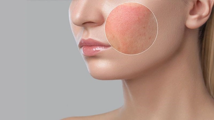 Hình Ảnh Dị Ứng Mỹ Phẩm: Dấu Hiệu, Nguyên Nhân & Cách Xử Lý Nhanh Cho Người Dùng Hình Ảnh Dị Ứng Mỹ Phẩm: Dấu Hiệu, Nguyên Nhân & Cách Xử Lý Nhanh Cho Người Dùng