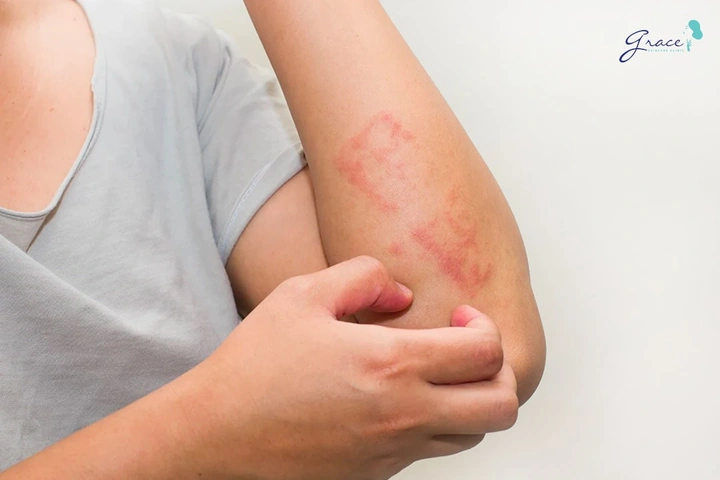 Hình Ảnh Dị Ứng Mỹ Phẩm: Dấu Hiệu, Nguyên Nhân & Cách Xử Lý Nhanh Cho Người Dùng Hình Ảnh Dị Ứng Mỹ Phẩm: Dấu Hiệu, Nguyên Nhân & Cách Xử Lý Nhanh Cho Người Dùng