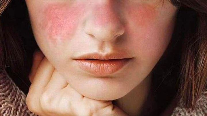 Hình Ảnh Dị Ứng Mỹ Phẩm: Dấu Hiệu, Nguyên Nhân & Cách Xử Lý Nhanh Cho Người Dùng Hình Ảnh Dị Ứng Mỹ Phẩm: Dấu Hiệu, Nguyên Nhân & Cách Xử Lý Nhanh Cho Người Dùng