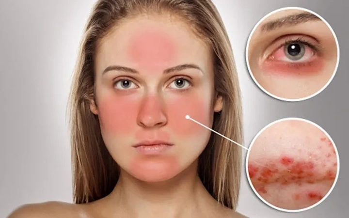 Hình Ảnh Dị Ứng Mỹ Phẩm: Dấu Hiệu, Nguyên Nhân & Cách Xử Lý Nhanh Cho Người Dùng Hình Ảnh Dị Ứng Mỹ Phẩm: Dấu Hiệu, Nguyên Nhân & Cách Xử Lý Nhanh Cho Người Dùng