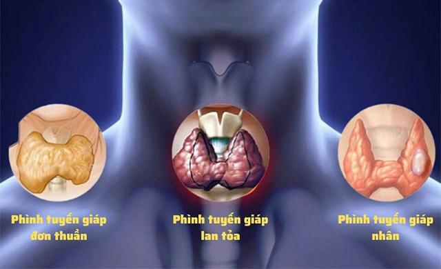 100+ Hình Ảnh Bướu Cổ Đơn Thuần 2026 - Bộ Sưu Tập Độc Đáo, Đẹp Nhất 100+ Hình Ảnh Bướu Cổ Đơn Thuần 2026 - Bộ Sưu Tập Độc Đáo, Đẹp Nhất